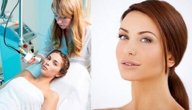 Hakekat prosedur rejuvenation kulit laser